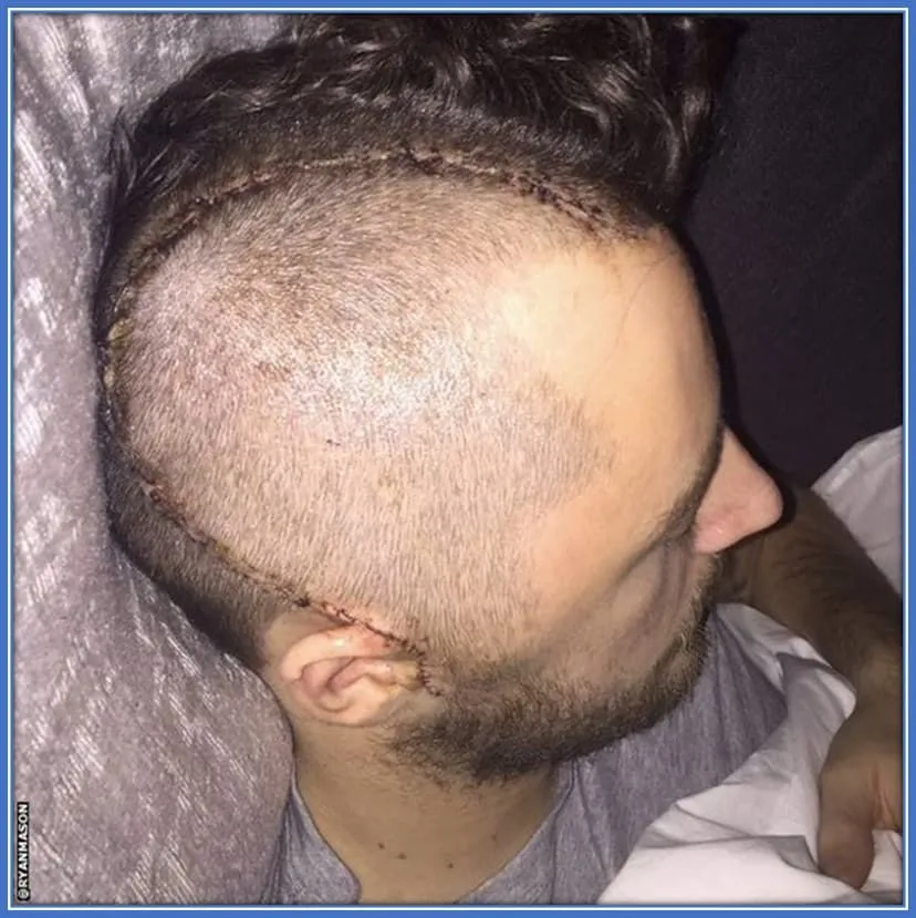A look at Ryan Mason Fractured Skull.