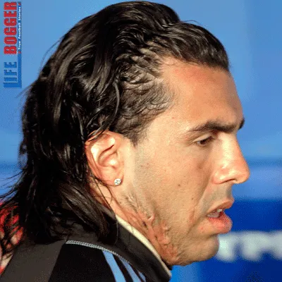 Why does Carlos Tevez have a Neck Scar?